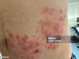 Image result for Varicella zoster on human skin