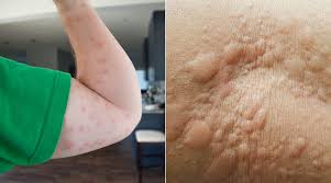 Bite mark, sting or sore on human skin. Bed Bugs Vs Hives How To Tell If It S Just A Bite Or An Allergic Reaction