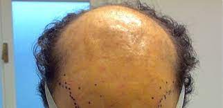 I poliambulatori medici tricomedit sono presenti a torino e alessandria da oltre 40. Trapianto Capelli In Italia Clinic Biorigeneral