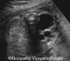 Multi Cystic Dysplastic Kidney Sonography Ultrasound Sonographer