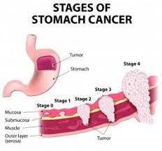 Do you believe your eating habits to be healthy? Stomach Cancer Gastric Adenocarcinoma Symptoms Causes And Treatment Science Online