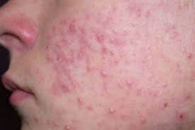 Image result for red rash face