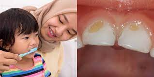 Maybe you would like to learn more about one of these? Karies Gigi Anak Berlaku Kerana Tiada Rutin Penjagaan Gigi Yang Baik