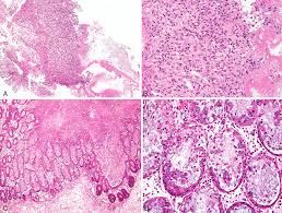 Image result for Neutropenic Colitis
