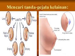 Tanda kanser payudara tahap 1. Glandula Mammae Kelenjar Buah Dada Oleh Dr Ibrahim