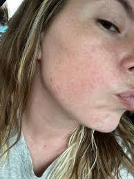 Chemical Peel Treatment for Texture and Hyperpigmentation Correction in  Livingston