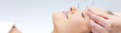 Facial Acupuncture Helen Turner