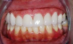 Befestigungszement Verfarbt Nicht Die Keramik Des Veneers Zwp Online Das Nachrichtenportal Fur Die Dentalbranche