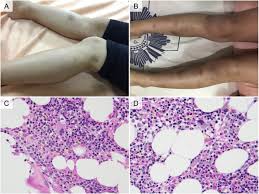 Image result for Platelet Dysfunction