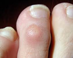 Image result for Corns