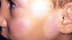 Image result for Postinflammatory Hypopigmentation