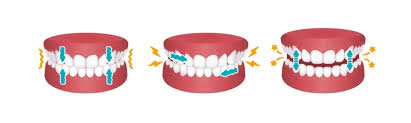 Teeth Grinding Appliance (Bruxism)