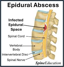 Image result for Spinal Epidural Abscess