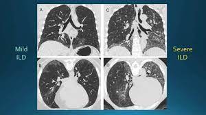 Webinar Treating Scleroderma Interstitial Lung Disease Ild With Dr Elizabeth Volkmann Youtube