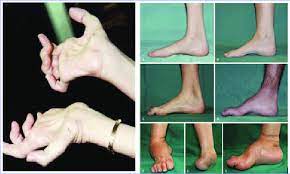 Maybe you would like to learn more about one of these? Overview Of Skeletal Disorders In The Legs And Hands Of Patients With Download Scientific Diagram
