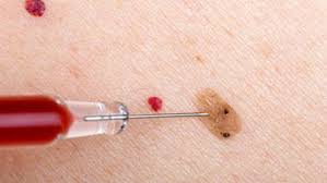 The damaged vessels inside the tumor are the reason for its bright red color. Cherry Angiomas Removal In Phoenix Az Mobile Skin Screening Services