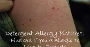 Allergies affect children everywhere and it can be difficult to know what to watch out for. Detergent Allergy Pictures Find Out If You Re Allergic To Laundry Detergent Laundry Detergent Allergy Method Laundry Detergent Allergic Reaction Rash