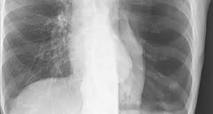 Respiratory findings may include the following Artificial Intelligence That Reads Chest X Rays Is Approved By Fda Uc San Francisco