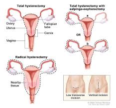Mehdi kebria, a gynecologic depending upon your symptoms or if you're at higher risk for endometrial cancer, a variety of different tests may be done to determine if you could have. Endometrial Cancer Hematology Oncology Associates Of Cny