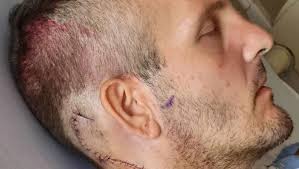 GoFundMe campaign started for beach-cleaning, brain tumour-surviving Cory  West