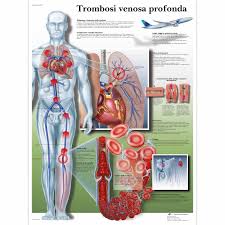 A trombose venosa profunda (tvp), condição conhecida popularmente apenas por trombose, é a formação de um coágulo sanguíneo em uma ou mais veias localizadas da parte inferior do corpo, geralmente nas pernas. Lehrtafel Trombose Venosa Profonda 1002037 Vr4368l Herz Kreislauf System 3b Scientific
