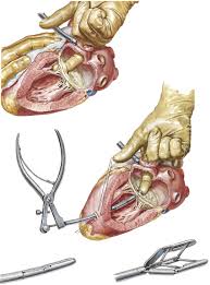 Example sentences from the web for mitral. 5 Closed Mitral Commissurotomy For Mitral Stenosis The Upper Image Download Scientific Diagram