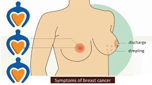 The earliest symptoms of breast cancer are easier to feel than see. Breast Cancer Symptoms And Treatment Youtube