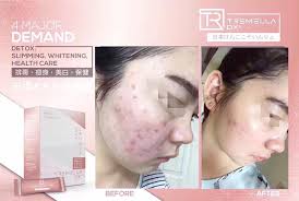 🔺Tremella-Dx+蔬果酵素一个疗程效果🔻 只需要1 个月，就能有那么大转变🙆🏻  鼓鼓胀胀的肚腩变扁了，肥胖纹不见了！就连手臂和大腿也瘦了，还变白了呢😘 最重要是不瘦胸！不反弹！不副作用！ 效果不是我说了算，有图有真相☑️  如果你试过了市面上的排毒产品，但是还没 ...