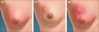 Image result for Inflammatory breast cancer