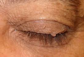 We did not find results for: Eye Lid Skin Tag News Tollgate Clinic