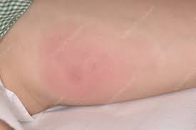 Allergic Reaction To An Insect Bite Stock Image C047 2831 Science Photo Library