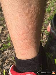 Unlike poison ivy that can cause painful blistering and intense itching for weeks afterward, stinging nettle rarely produces a blistery rash and the worst of the uncomfortable sting typically diminishes within a few hours. Stinging Nettle Rash 04 Oh God My Wife Is German