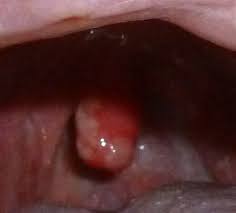 Image result for Uvulitis