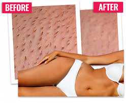 Yet, the grooming of the pubic hair area is a key priority for women. Intimate Hair Remover Hairfree Hair Removal Permanent Laser Hair Removal Bikini Hair Removal