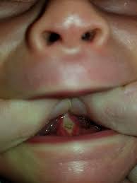 Nov 26, 2016 · sometimes, baby's mouth isn't fully developed during his time in the womb, and there may be a part missing. Aftercare Drghaheri Com