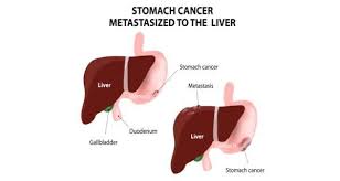 That's probably the most concerning symptom. Stomach Cancer Health Tips Stomach Cancer Health Articles Health News Thehealthsite Com