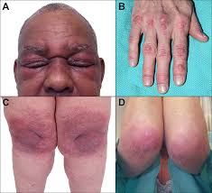 Image result for Dermatomyositis
