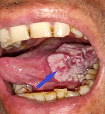 Image result for cancer of tongue