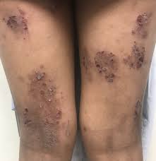 Image result for Photodermatitis