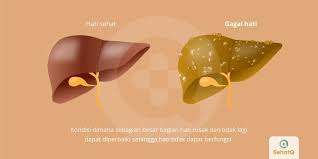 Results updated daily for kronik energy drink Gagal Hati Tanda Dan Gejala Penyebab Cara Mengobati Cara Mencegah