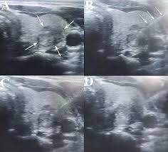 Update profile view full profile. Frontiers A Propensity Score Matching Study Between Microwave Ablation And Radiofrequency Ablation In Terms Of Safety And Efficacy For Benign Thyroid Nodules Treatment Endocrinology