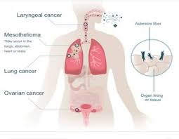 Check spelling or type a new query. Mesothelioma Lung Cancer