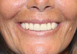 Jun 14, 2021 · contact the clinic directly to discuss prices for individual services which vary. Dallas Dentures Lowest Price On Dentures In Dallas Tx