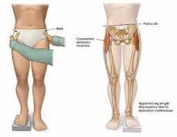 Image result for Functional Leg Length Discrepancy
