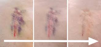 Bei einem bluterguss (hämatom) tritt blut aus den gefässen in das umliegende gewebe aus. Wie Lange Dauert Es Bis Ein Bluterguss Heilt