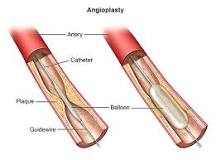Image result for which of the following is a treatment for heart disease?balloon angioplasty