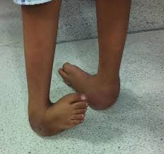 Image result for Clubfoot