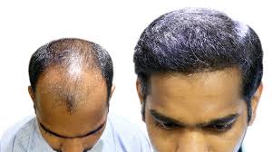 Hair transplant hair initially shed off in 6 weeks time. Hair Transplant Growth Timeline New Roots Hair Transplant Clinic