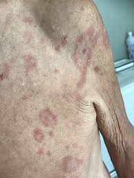 Image result for Secondary Syphilis