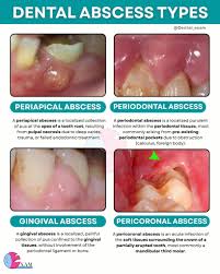 Image result for Periodontal Abscess